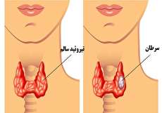 علت و علائم سرطان تیروئید چیست و چگونه درمان میشود؟