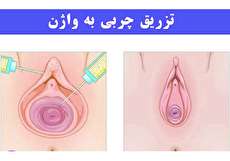 تزریق چربی به واژن؛ مزایا، معایب و روش انجام آن