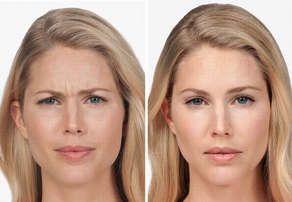 عوارض بوتاکس پیشانی و روشهای برطرف کردن آن عوارض تزریق بوتاکس پیشانی