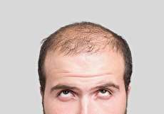 انواع قرص برای رشد سریع موها و کاربرد هر کدام