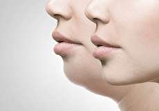 مزوتراپی غبغب چیست و چگونه انجام میشود؟