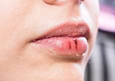 علت خشکی لب چیست؟ ۱۱ دلیل شایع و راههای درمان آن