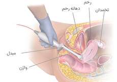 تفسیر سونوگرافی واژینال و نحوه انجام آن
