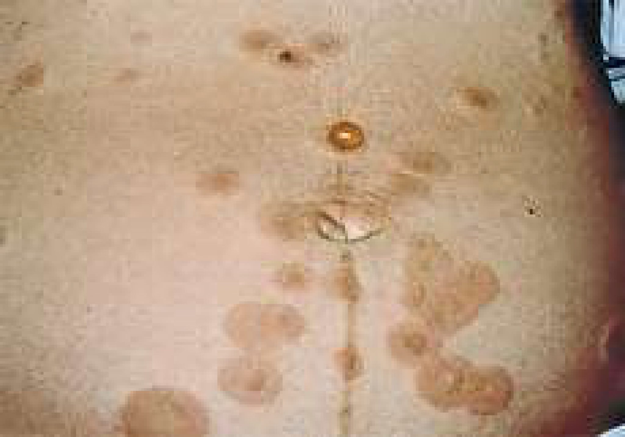 دلایل ایجاد لکه‌ های قهوه‌ ای روی پوست شکم چیست؟ ستاره