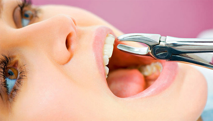 مراقبت‌ های بعد از کشیدن دندان