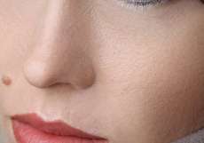 برداشتن خال گوشتی به روشهای پزشکی و خانگی