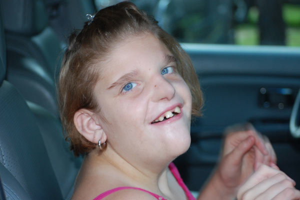 سندروم مووات ویلسون (Mowat-Wilson Syndrome) چیست؟ سندروم مووات ویلسون (Mowat-Wilson Syndrome) چیست؟