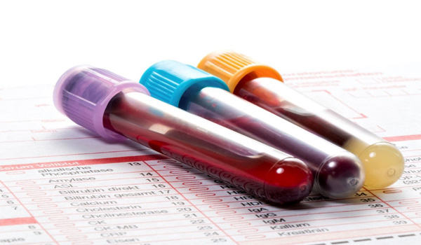 تشخیص پلاکت خون بالا با آزمایش خون 