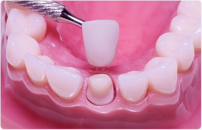 درمان عفونت دندان روکش شده