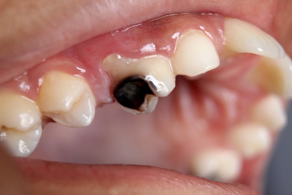 عوارض دندان پوسیده؛ برای جلوگیری از پوسیدگی دندان چه کارهایی انجام دهیم؟