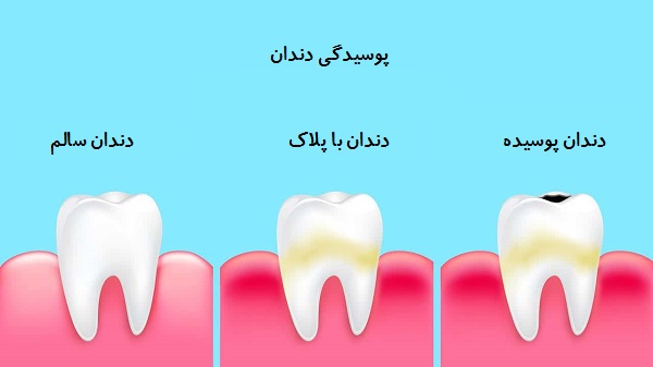 عوارض دندان پوسیده؛ برای جلوگیری از پوسیدگی دندان چه کارهایی انجام دهیم؟