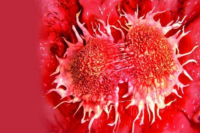 متاستاز سرطان تیروئید؛ سرطان تیروئید به کدام اندام‌ها حمله می‌کند؟