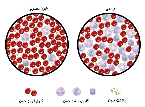 انواع سرطان خون؛ علائم و راه‌های درمان برای سرطان‌های لوسمی، لنفوم و میلوما