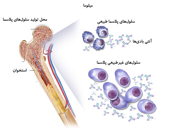 انواع سرطان خون؛ علائم و راه‌های درمان برای سرطان‌های لوسمی، لنفوم و میلوما