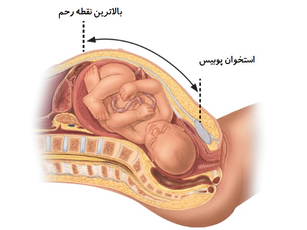 جنين درشت (ماكروزومي)؛ چطور از ماكروزومي جنين جلوگيري كنيم؟