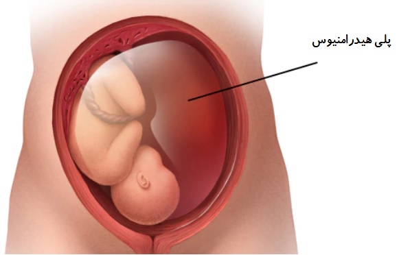 جنين درشت (ماكروزومي)؛ چطور از ماكروزومي جنين جلوگيري كنيم؟