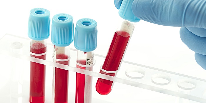 تفسیر آزمایش خون CRP؛ آزمایش پروتئین فعال سی