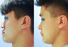 تاثیر جراحی فک بر چهره شامل چه مواردی میشود؟