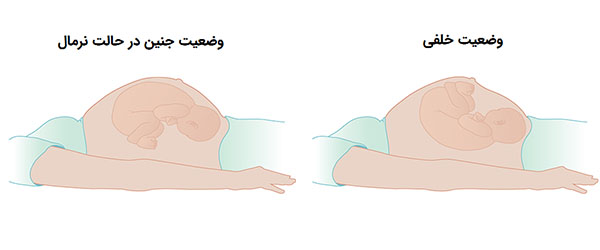 جفت خلفی و طبیعی