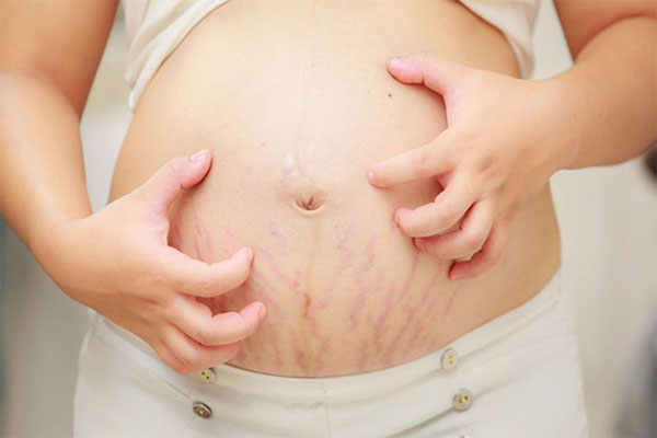 پیشگیری از ترک شکم در بارداری