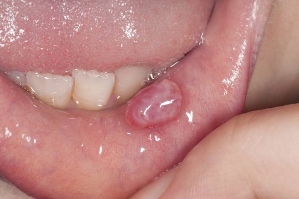 موکوسل دهانی چیست؟ علائم، دلایل ظهور و راه‌های درمان