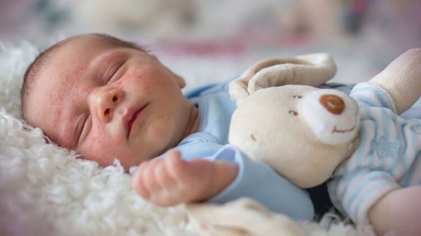 جوش صورت نوزاد | علت، علائم و درمان