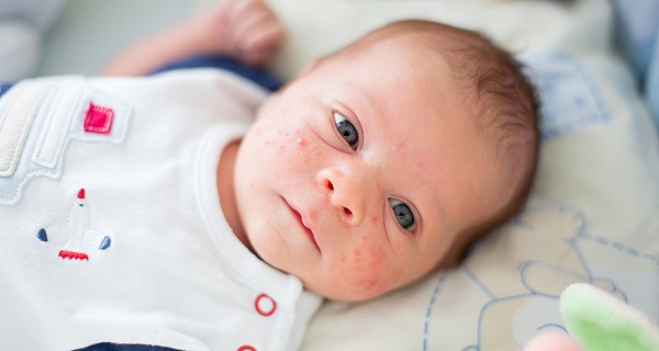 جوش صورت نوزاد | علت، علائم و درمان