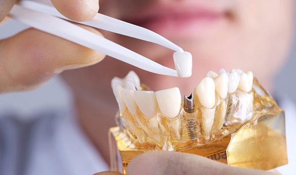 انواع مختلف پروتز دندان؛ ایمپلنت
