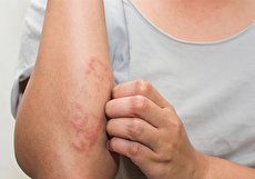 داروی آسیترتین چیست و در چه مواردی تجویز میشود؟