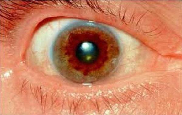 سفیدی چشم نشانه بیماری ویلسون