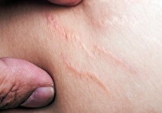 رفع ترک های پوستی با روش های پزشکی و خانگی