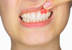 علت بروز جوش لثه و راه های درمان آن چیست؟