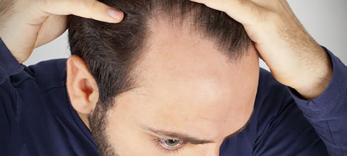 تعداد طبیعی ریزش مو روزانه در مردان