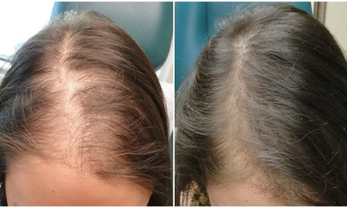 تعداد طبیعی ریزش مو روزانه در زنان