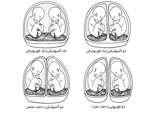 انواع تقسیم تخمک در باروری دوقلو همسان