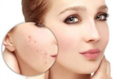 از بین بردن جوش در یک شب با راه حل های معجزه آسا!