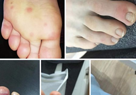 یکی دیگر از علائم پوستی کرونا شناسایی شد