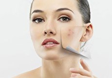 از بین بردن لک صورت با روش های موثر خانگی و پزشکی