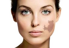 علت ماه گرفتگی پوست چیست و چگونه درمان می شود؟