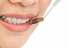 لمینت سرامیکی دندان چه فواید و معایبی نسبت به لمینت کامپوزیت دارد؟
