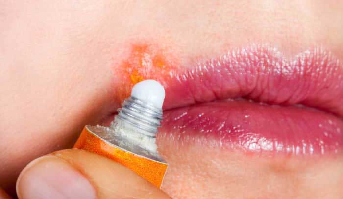 معرفی چند پماد تبخال لب و درمانهای خانگی آن معرفی چند پماد تبخال لب و درمانهای خانگی آن