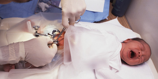 بهترین روش ختنه نوزاد پسر روش حلقه است یا جراحی؟