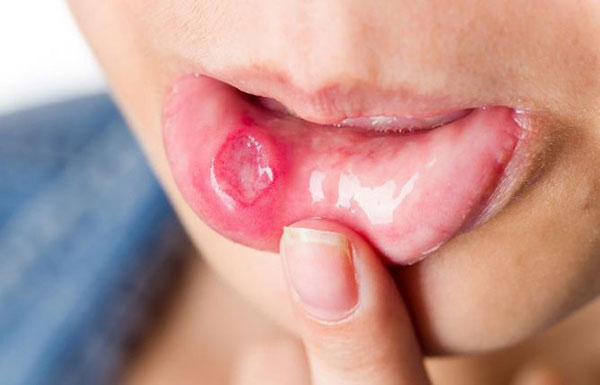 راه های درمان آفت دهان به صورت خانگی 